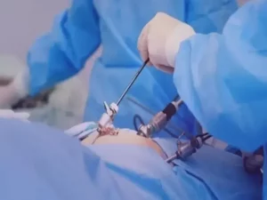 عمل جراحی لاپاراسکوپی و باز