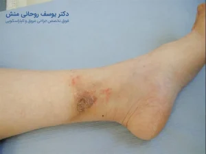 زخم واریس