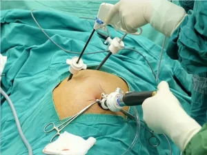 لاپاراسکوپی پیشرفته