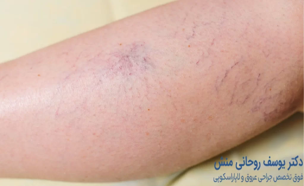 رگ های عنکبوتی