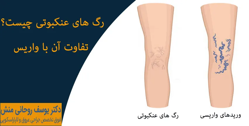 رگ های عنکبوتی چیست و تفاوت آن با واریس