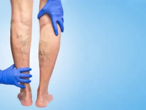 علائم واریس