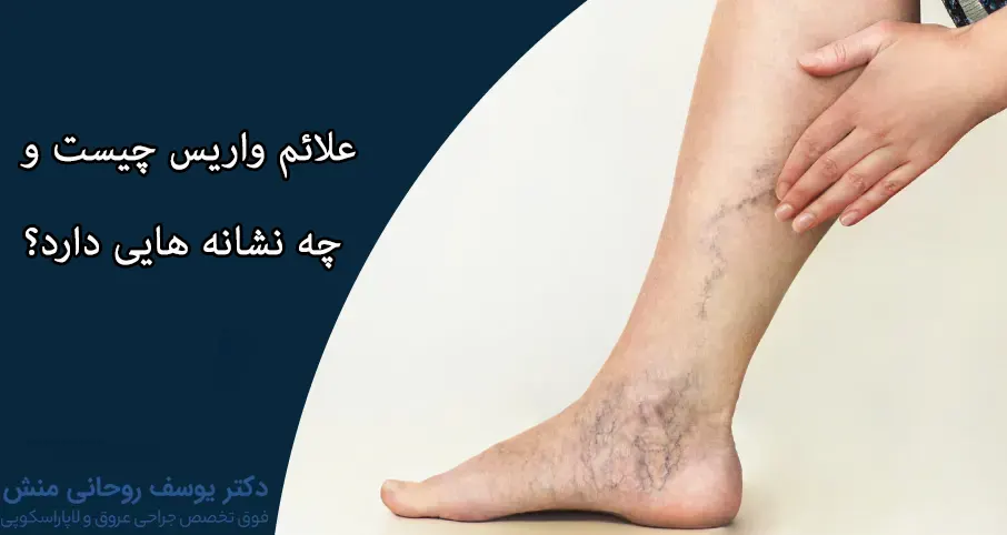علت و علائم واریس