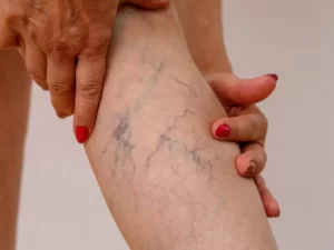 پیشگیری از واریس پا