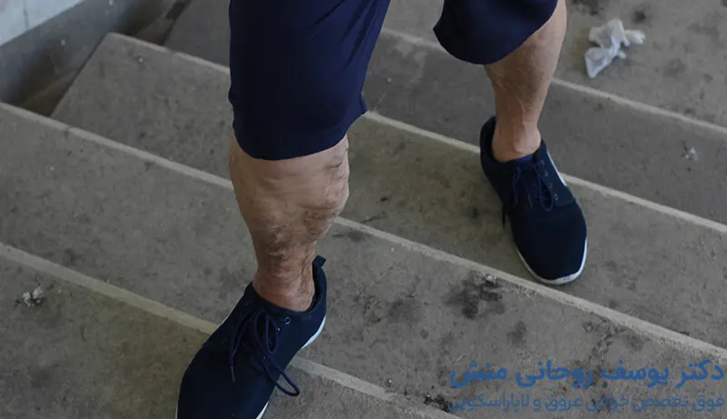 علل واریس پا در مردان