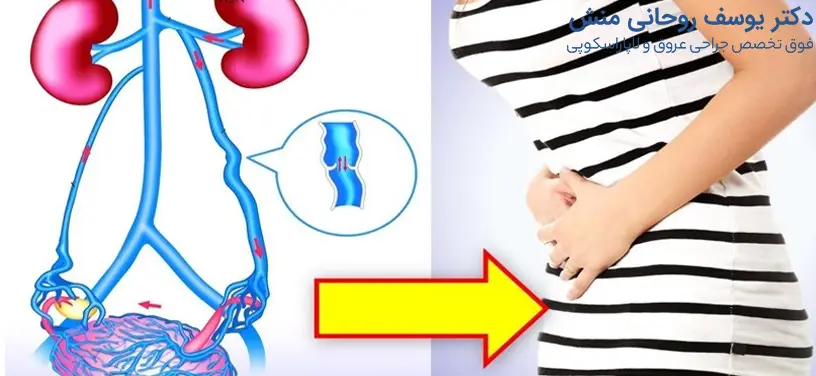 واریس لگن و سندروم احتقان لگنی