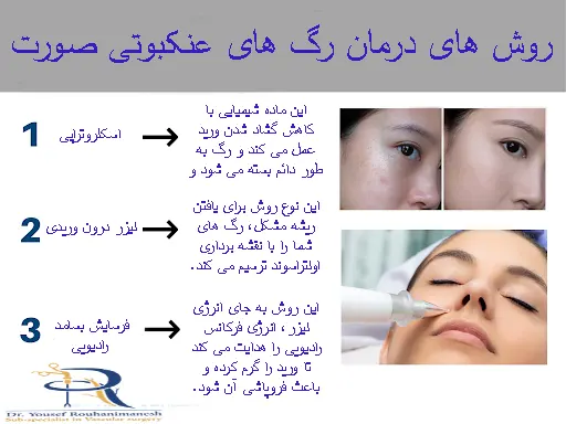 روش های درمان رگ های عنکبوتی صورت