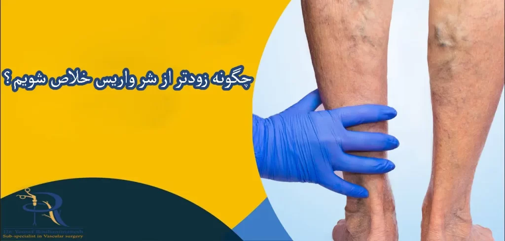 درمان سریع واریس