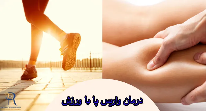 درمان واریس پا با ورزش